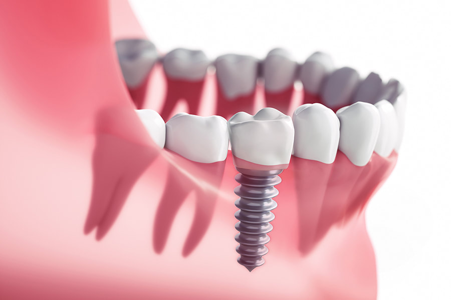 Dental Implants_Edward's Denture Clinic